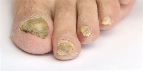 The Best Fungal Toe Nail Treatment Taylors Lakes Podiatry Clinic