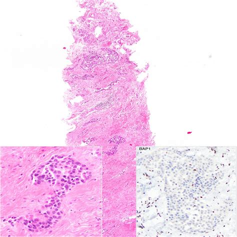 The Separation Of Benign And Malignant Mesothelial Prolifera The