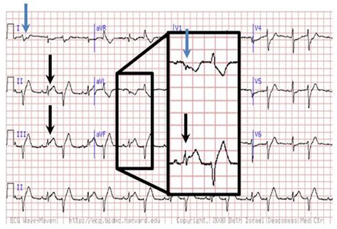 Are You Missing Subtle Mi Clues On Ecgs Test Your Skills
