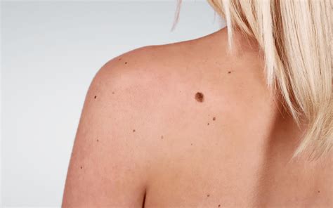 If you have had skin cancer, your dermatologist can tell you how often you should check your skin. Skin Cancer Screening | Persona Med-Aesthetic Centre Malta
