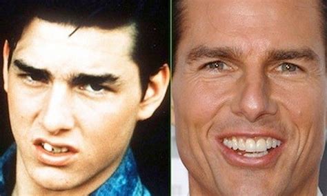 Tom Cruise Before And After Teeth Midline Discrepancy How It Affects