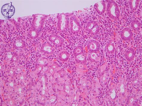 8esophagus Stomach 4 Gastritis Chronic Gastritispathology Core