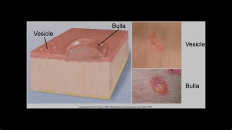 Start studying types of skin lesions. different type skin lesions and their morphology :macule ...