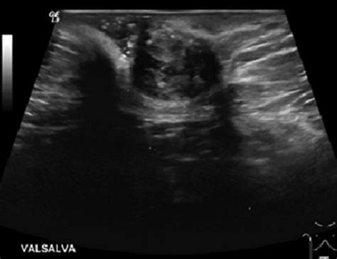 The Ultrasound Demonstrates A 17 X 15 X 13cm Pocket Containing