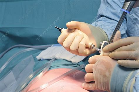 Keyhole Kidney Removal Surgery Stock Image C0105045 Science