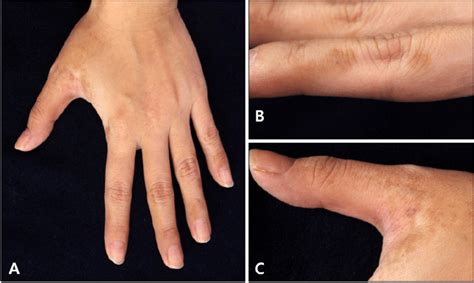 A Multiple Brown Pigmented Patches On The Left Hand B On The
