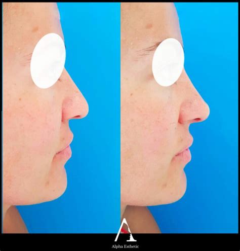 Les injection d acide hyaluronique du nez ou rhinoplastie médicale