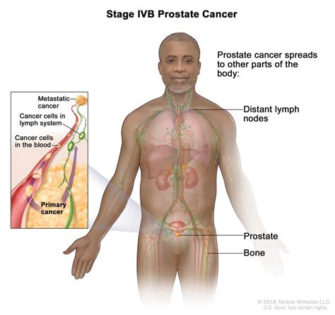 Prostate Cancer Vanderbilt Ingram Cancer Center