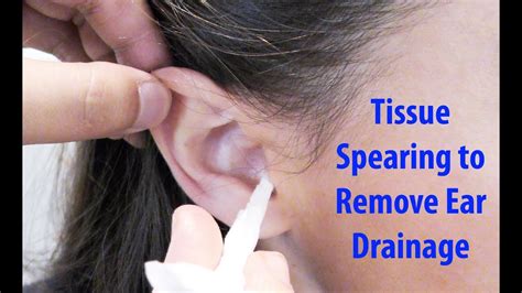Tissue Spears To Remove Ear Drainage Youtube