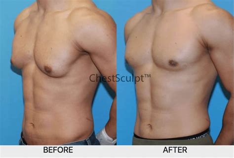 Liposuction For Men S Chest Ezequiel Martindale