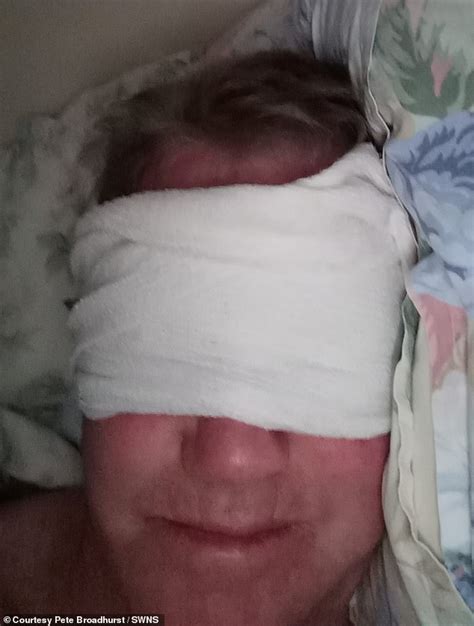 Pensioner Claims Botched £11000 Surgery Means He Hanst Been Able To Close His Eyes For Three