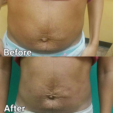 Laser Lipo Before And After In Tampa Bellissimo You