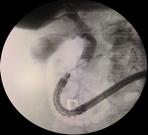 Transjejunal Laparoscopic Assisted Ercp In Roux En Y Patient The New