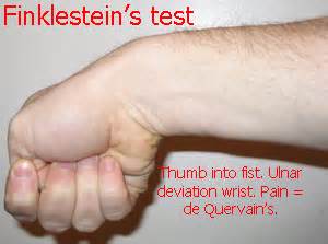 The condition called de quervain's tenosynovitis causes pain on the inside of the wrist and forearm just above the thumb. De Quervain's Tenosynovitis