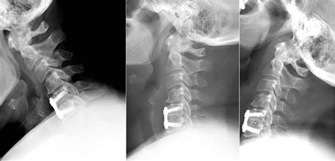 Maintaining Neck Motion Cervical Disc Replacement