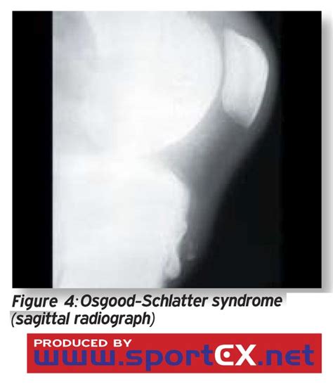 Osgood Schlatter Syndrome Sagittal Radiograph A Photo On Flickriver