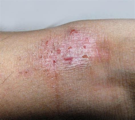 Dark Dry Spots On Skin