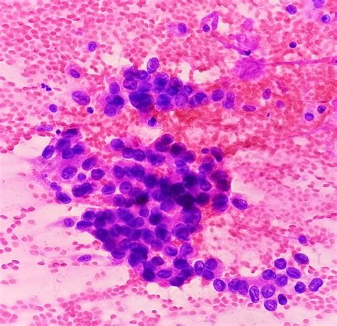 Premium Photo Adenocarcinoma Of Lung A Type Of Non Small Cell