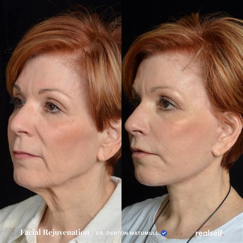 12 Facelift Recovery Tips To Know Facelift Recovery Face Lift