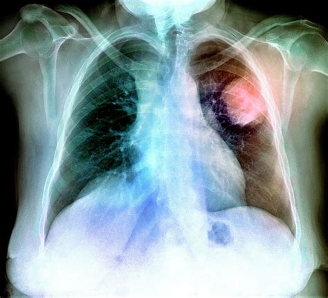 Lung Cancer X Ray Photograph By Du Cane Medical Imaging Ltd My XXX