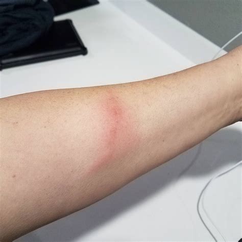 Think These Are Bedbug Bites I Have Them On Both Arms They Itch And