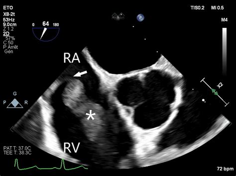 Transesophageal Echocardiogram Mid Esophageal Right Ventricle