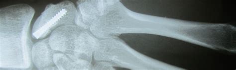 Scaphoid Fracture Treatment In Raleigh Durham Chapel
