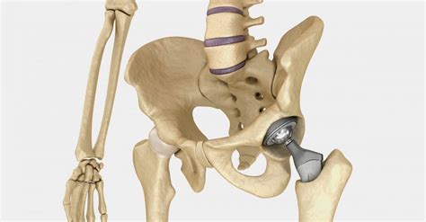 Hip Implant Ford Law Nationwide