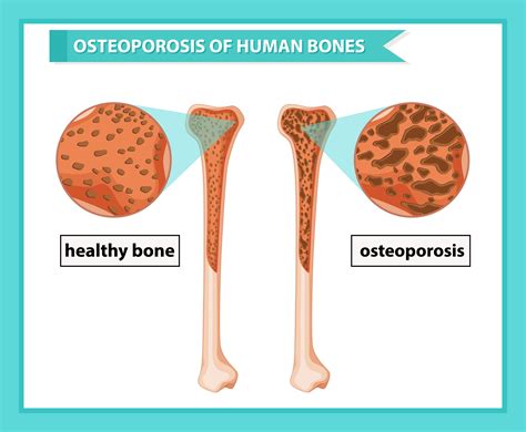 Scientific Medical Illustration Of Osteoporosis Of Bones 685438 Vector