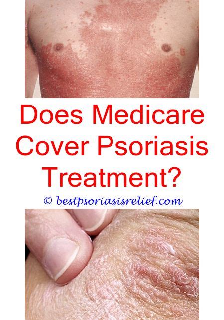 Pin On Scalp Psoriasis Causes