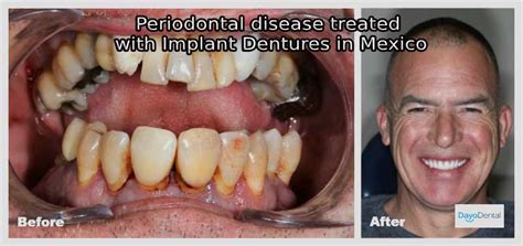 2up 1 Final Image Moderate Periodontal Disease Dayo Dental