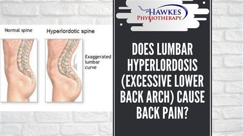 Does Lumbar Hyperlordosis Excessive Lower Back Arch Cause Back Pain