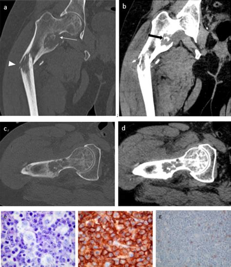 Radiological Features Of Bone Lymphoma On Ct And Mri A Retrospective