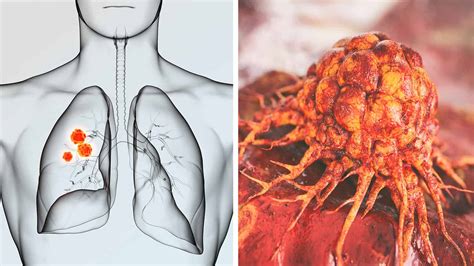 oncologists explain  lung cancer symptoms   ignore