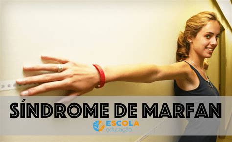 Síndrome De Marfan O Que é Causas Sintomas Diagnóstico Tratamento