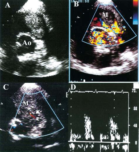 Obstruction Of Right Ventricular Outflow Tract By Extended Cardiac