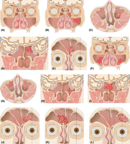 Origin Site‐based Staging System Of Sinonasal Inverted Papilloma For