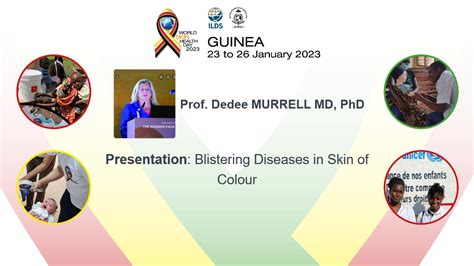 Blistering Diseases In Skin Of Colour Global Dermatology