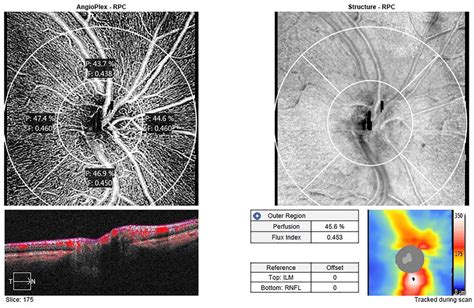 Optic Nerve Head Evaluation With Optical Coherence Tomography