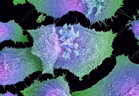 Lung Cancer Cells SEM Stock Image C058 6060 Science Photo Library