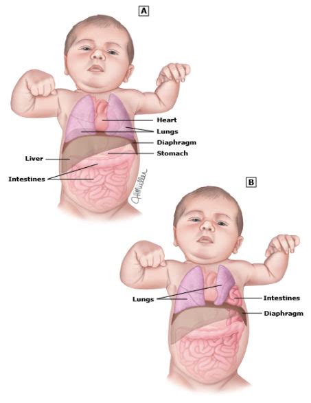 Congenital Diaphragmatic Hernia Cdh
