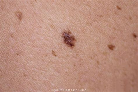 A Guide To The Atypical Mole South East Skin Clinic