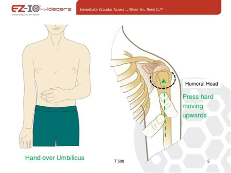 Ppt Proximal Humeral Io Powerpoint Presentation Free Download Id