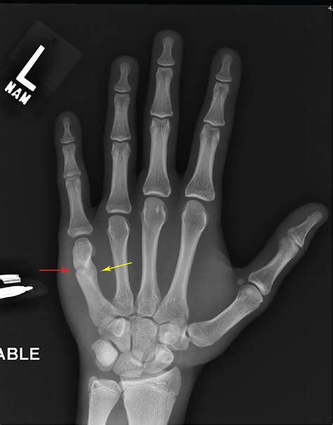 Punchin Out Fifth Metacarpal Boxers Fracture Radiology Key