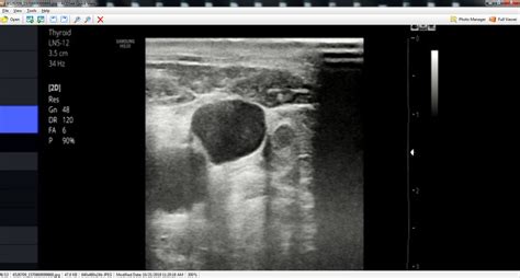 Vietnamese Medic Ultrasound Case 568 Subacute Thyroiditis De Quervain