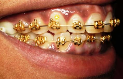 Gold Braces Only In Beverly Hills Extravaganzi