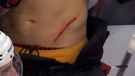 See It Flyers Center Brayden Schenn Suffers Nasty Cut To