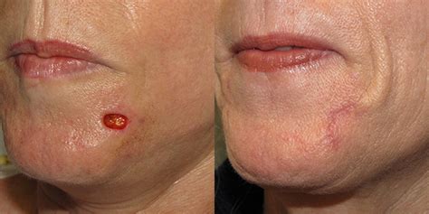 Chin Reconstruction Gallery Skin Cancer And Reconstructive Surgery Center