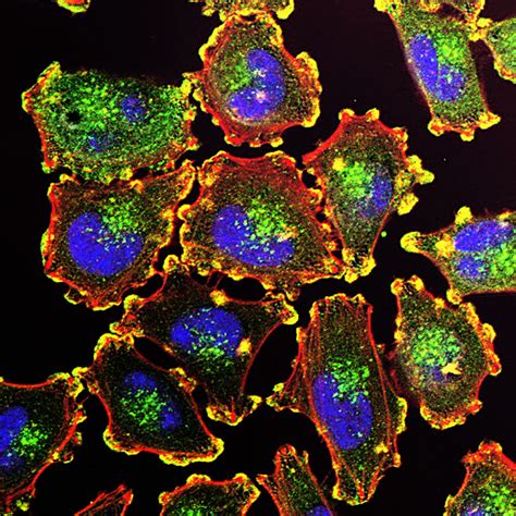 Metastatic Melanoma Cells The Ability Of Cancer Cells To M Flickr