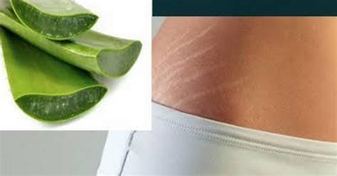 Beauty Tips How To Get Rid Of Stretch Marks With Aloe Vera Pulse Ghana